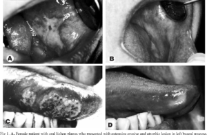 Read more about the article Clinical Trial With Clobetasol and Dexamethasone for Topical Treatment of Oral Lesions of Chronic Graft-versus-host Disease