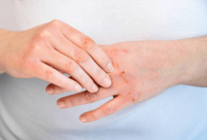 Dermatitis Treatment