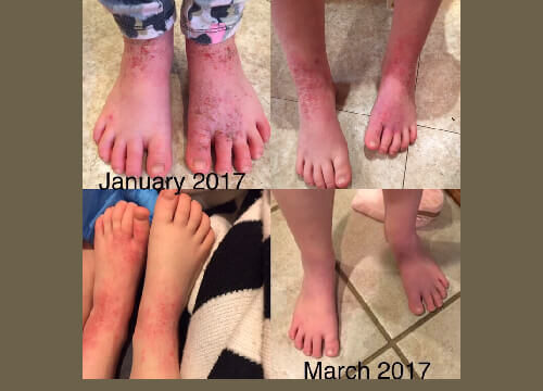 Ainsley before and after treatment