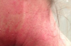 Red skinrash from eczema and dermatitis